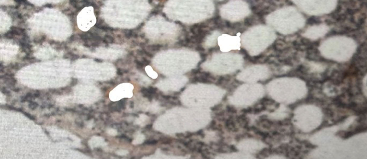 Megakaryocyte proteome in myeloproliferative neoplasms