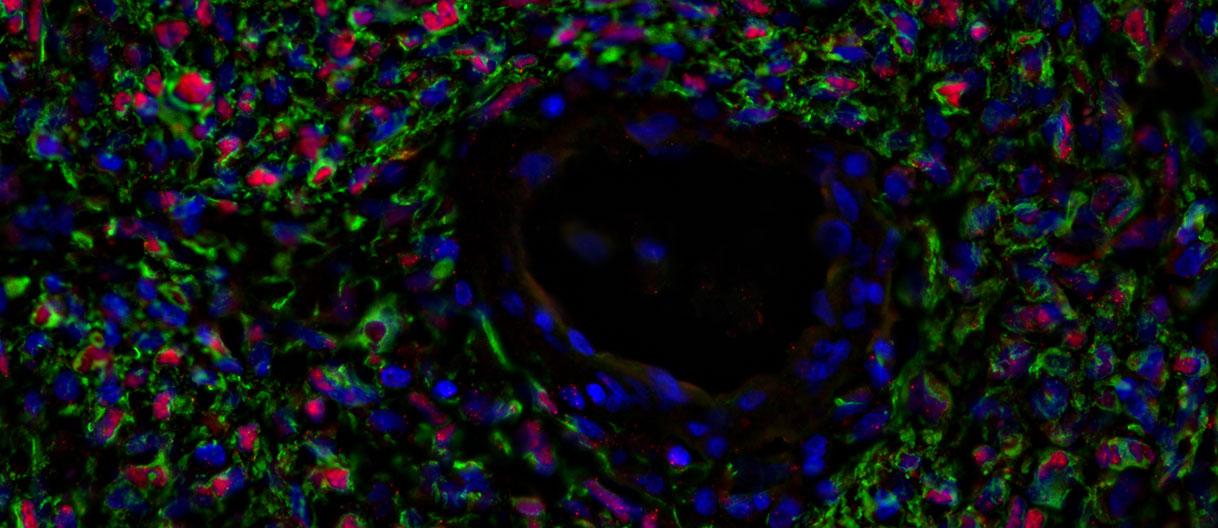 Precision oncology in a dish: Patient-derived glioma organoids to guide novel therapeutic strategies